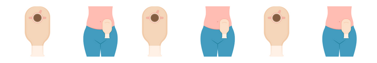 Ostomy