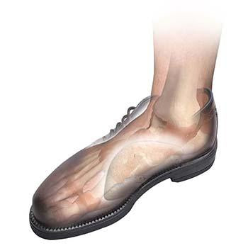 Load image into Gallery viewer, Hapad Scaphoid Pads