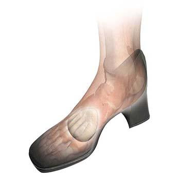 Load image into Gallery viewer, Hapad Metatarsal Cookies