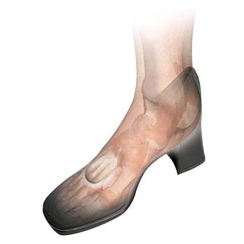 Load image into Gallery viewer, HAPAD Neuroma Pads