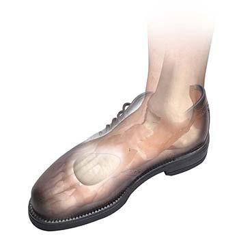 Hapad Metatarsal Pads