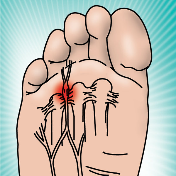 Load image into Gallery viewer, HAPAD Neuroma Pads