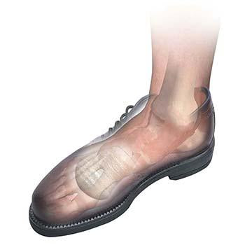 Load image into Gallery viewer, Hapad Metatarsal Bars

